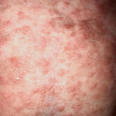 pyoderma without hair